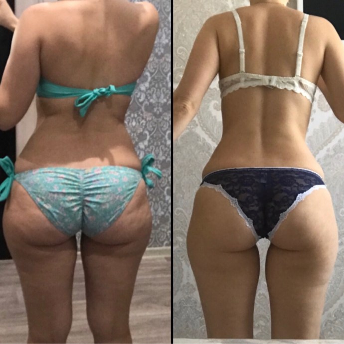 Cellulite legs and buttocks