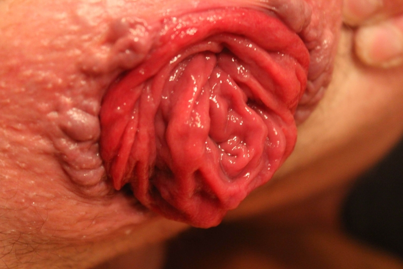 Grandmother prolapse vagina