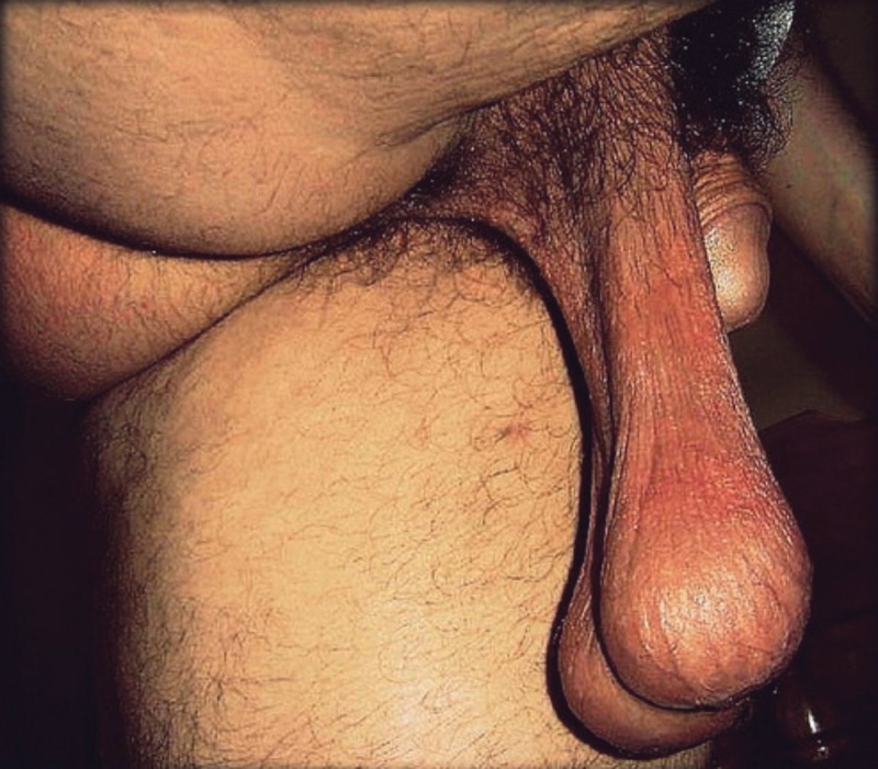 The old sagging scrotum